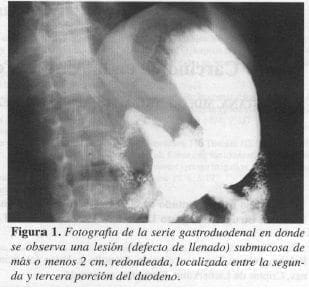 Serie Gastroduodenal en donde se observa una Lesión