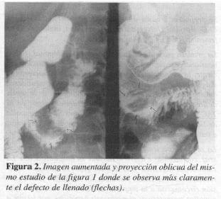 Serie Gastroduodenal, Imagen aumentada
