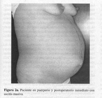Paciente en puerperio y postoperatorio inmediato con ascitis masiva. Paciente en puerperio y postoperatorio inmediato con ascitis masiva