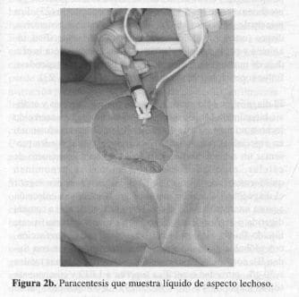 Paracentesis que muestra líquido de Aspecto Lechoso Paracentesis que muestra líquido de Aspecto Lechoso