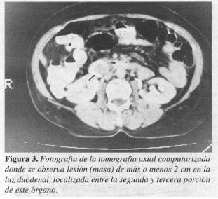 Luz Duodenal Luz Duodenal