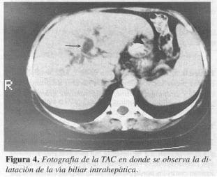 Dilatación de la Vía Biliar Intrahepática Dilatación de la Vía Biliar Intrahepática