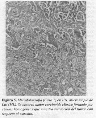 Tumor Carcinoide clásico formado por Células Homogéneas Tumor Carcinoide clásico formado por Células Homogéneas