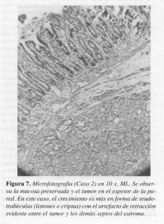 Mucosa Preservada y el Tumor en el Espesor de la Pared Mucosa Preservada y el Tumor en el Espesor de la Pared