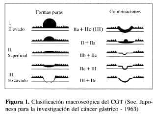 Carcinoma Gástrico Temprano, Clasificación macroscópica
