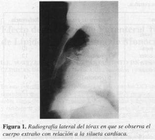 Radiografía lateral del Tórax