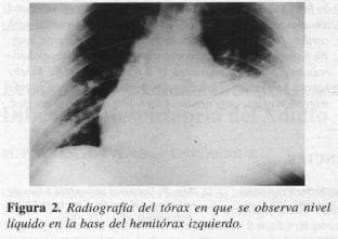 Hemitórax Izquierdo Hemitórax Izquierdo