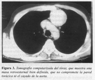 Masa Retroesternal bien Definida