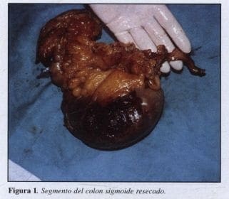 Segmento del Colon Sigmoide Resecado