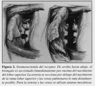 Trasplante Pulmonar, Neumonectomía del receptor Trasplante Pulmonar, Neumonectomía del receptor
