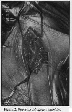 Disección del paquete Carotídeo Disección del paquete Carotídeo