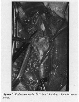 Endarterectomía Endarterectomía