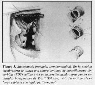 Anastomosis Bronquial Terminoterminal Anastomosis Bronquial Terminoterminal