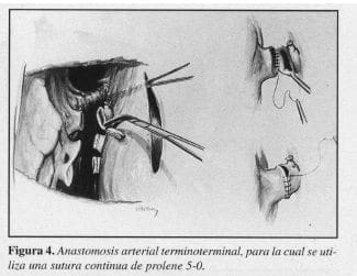 Anastomosis Arterial Terminoterminal Anastomosis Arterial Terminoterminal