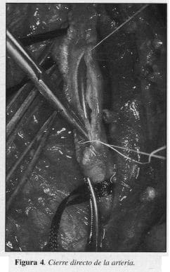 Cierre directo de la Arteria Cierre directo de la Arteria