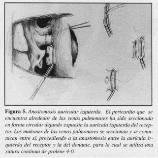 Anastomosis Arterial Terminoterminal Anastomosis Arterial Terminoterminal