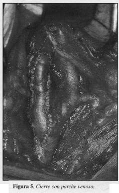 Cierre con parche venoso Cierre con parche venoso
