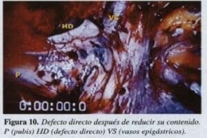 Defecto Directo después de reducir su Contenido Defecto Directo después de reducir su Contenido