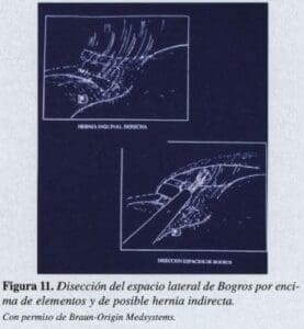 Disección del espacio lateral de Bogros Disección del espacio lateral de Bogros