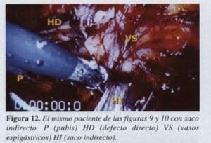 Herniorrafia Inguinal, Saco Indirecto. Herniorrafia Inguinal, Saco Indirecto.