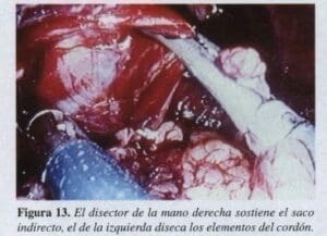 Herniorrafia Inguinal, El disector de la mano Herniorrafia Inguinal, El disector de la mano