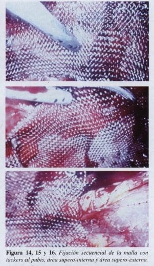 Herniorrafia Inguinal, Fijación secuencial de la malla Herniorrafia Inguinal, Fijación secuencial de la malla