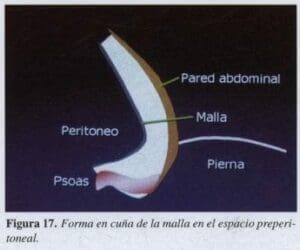 Herniorrafia Inguinal, Forma en cuña de la malla Herniorrafia Inguinal, Forma en cuña de la malla