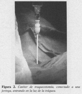 Catéter de Traqueostomía