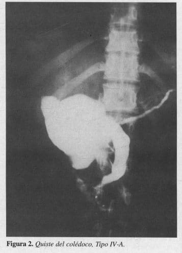 Quiste del colédoco, Tipo IV-A.