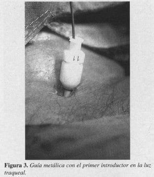 Guía Metálica con el primer introductor en la luz Traqueal