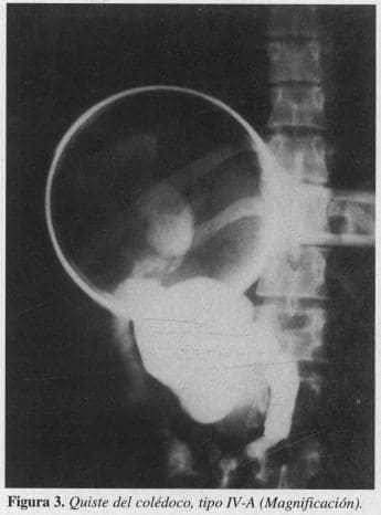 Quiste del colédoco, tipo IV-A (Magnificación)