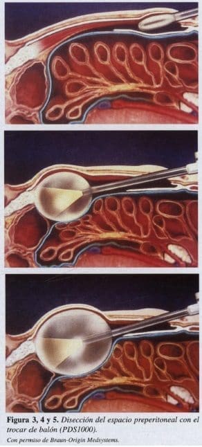 Herniorrafia Inguinal, Disección del espacio preperitoneal Herniorrafia Inguinal, Disección del espacio preperitoneal