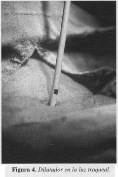 Dilatador en la luz Traqueal