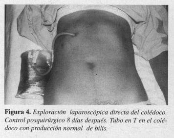 Exploración Laparoscópica Directa del Colédoco