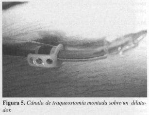 Cánula de Traqueostomía