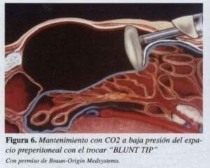 Herniorrafia Inguinal, Mantenimiento con C02  Herniorrafia Inguinal, Mantenimiento con C02