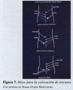 Herniorrafia Inguinal, Sitios para la colocación de trocares Herniorrafia Inguinal, Sitios para la colocación de trocares