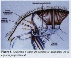Desarrollo Herniarios en el Espacio Preperitoneal Desarrollo Herniarios en el Espacio Preperitoneal