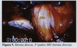 Hernia Directa Hernia Directa