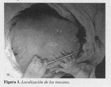 Adrenalectomía, Localización de los trocares
