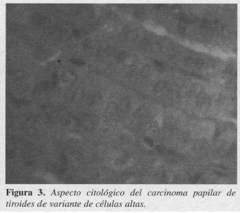 Aspecto Citológico del Carcinoma Papilar Aspecto Citológico del Carcinoma Papilar