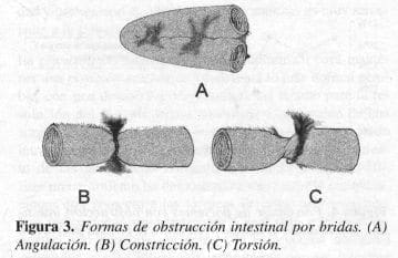 Formas de Obstrucción Intestinal por Bridas