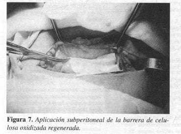 Barrera de Celulosa Oxidizada Regenerada