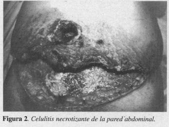 Celulitis Necrotizante de la pared Abdominal Celulitis Necrotizante de la pared Abdominal