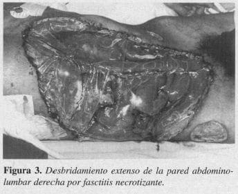 Fasctitis Necrotizante Fasctitis Necrotizante