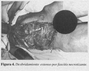 Desbridamiento extenso por Fascitis Necrotizante Desbridamiento extenso por Fascitis Necrotizante