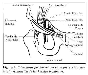 Herniorrafia Preperitoneal: structuras fundamentales en la prevención natural