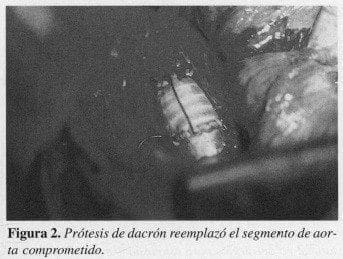 Prótesis de Dacrón reemplazó el segmento de Aorta comprometido Prótesis de Dacrón reemplazó el segmento de Aorta comprometido