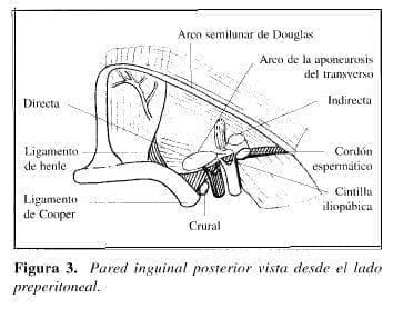 Herniorrafia Preperitoneal: Pared inguinal