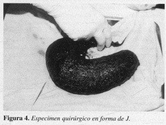 Especimen quirúrgico enforma de J.
